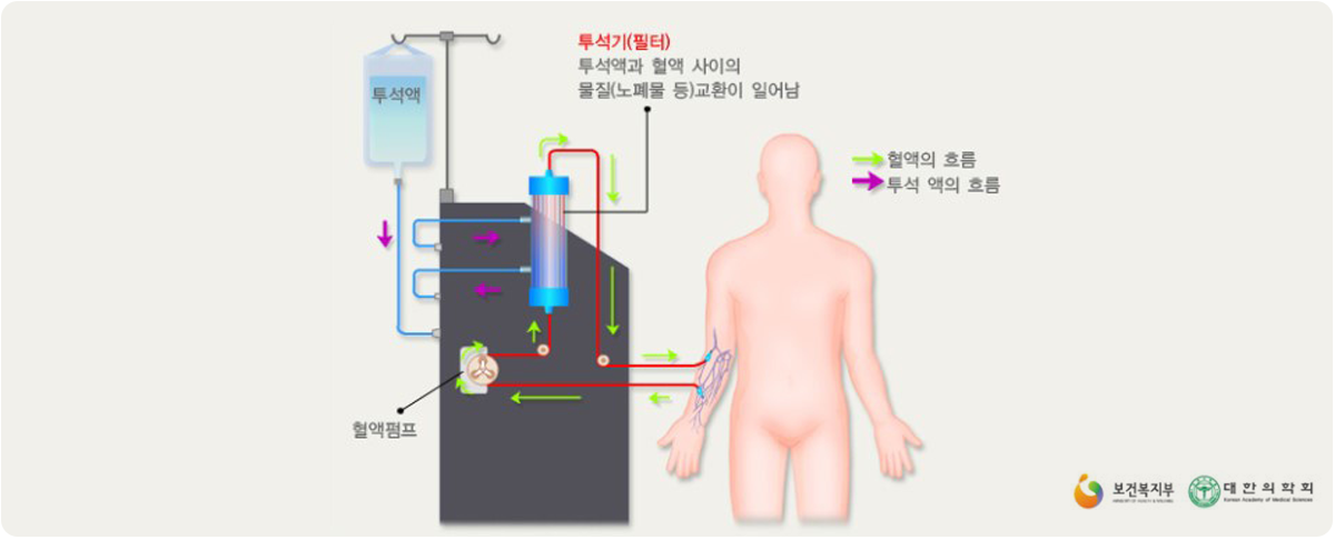 혈액투석 보식도