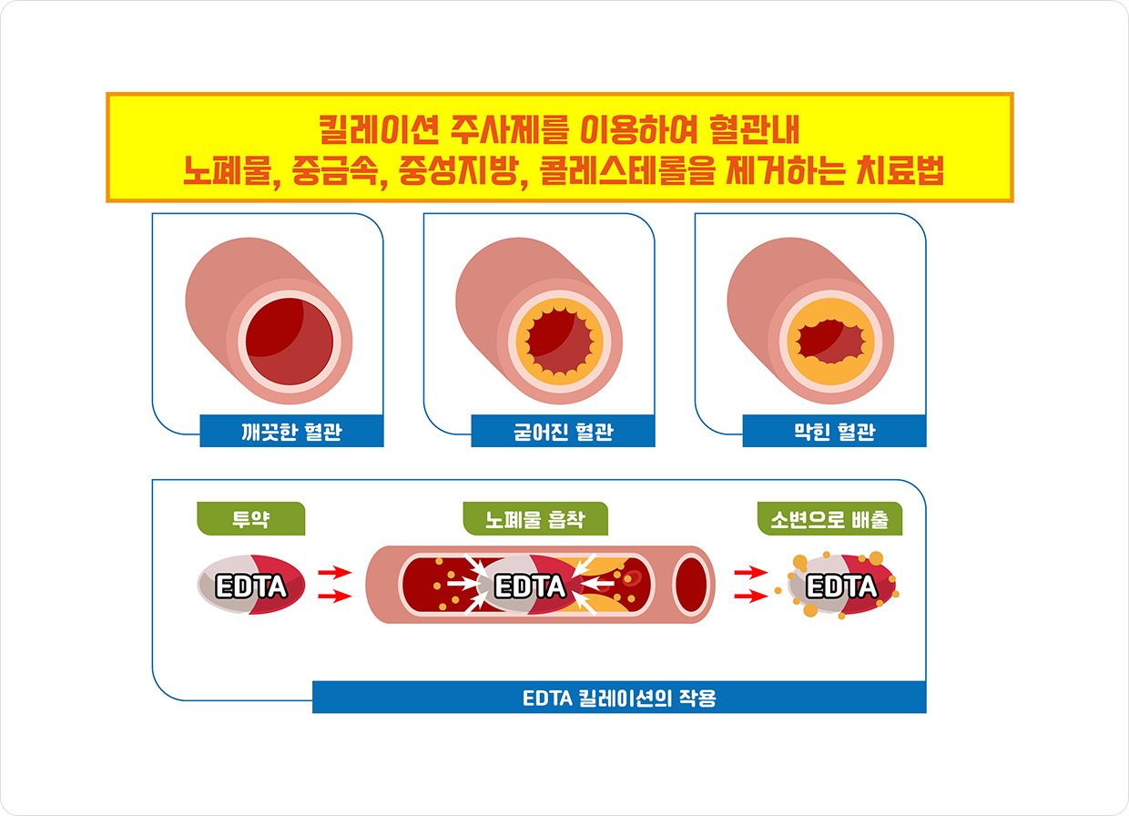 킬레이션 주사제를 이용하여 혈관내 노폐물, 중금속, 중성지방, 콜레스테롤을 제거하는 치료법