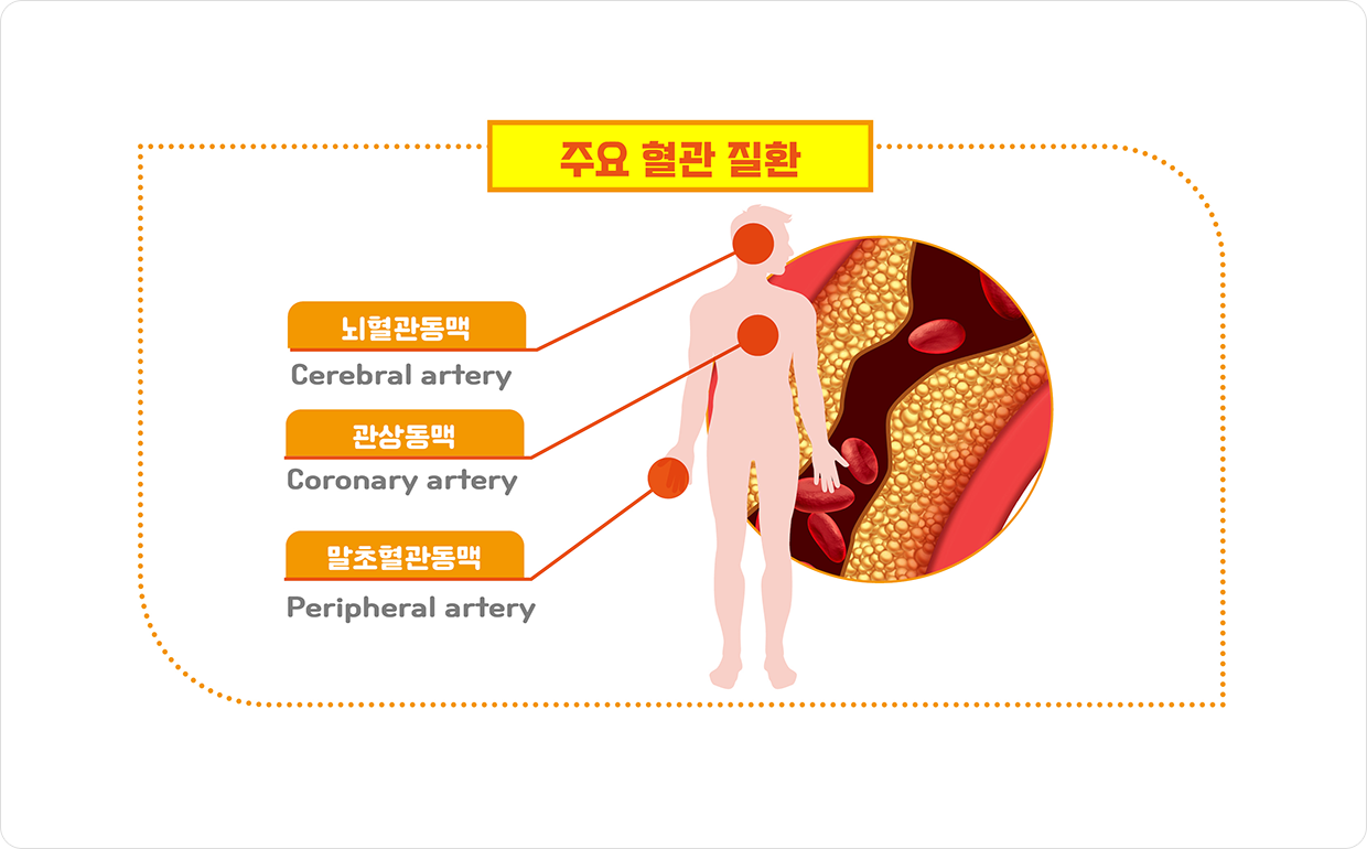주요 혈관 질환 : 뇌혈관동맥, 관상동맥, 말초혈관동맥